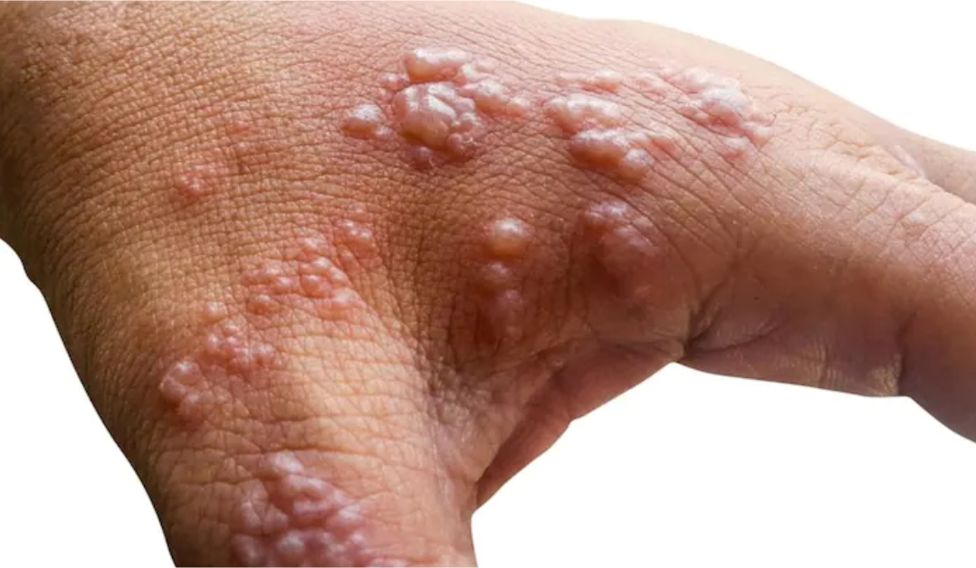 Abia confirms 9 monkeypox instances