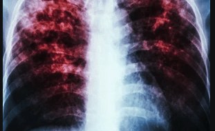 South Africa: As With Covid-19, the Results of TB Can Linger Lengthy After It Is Cured