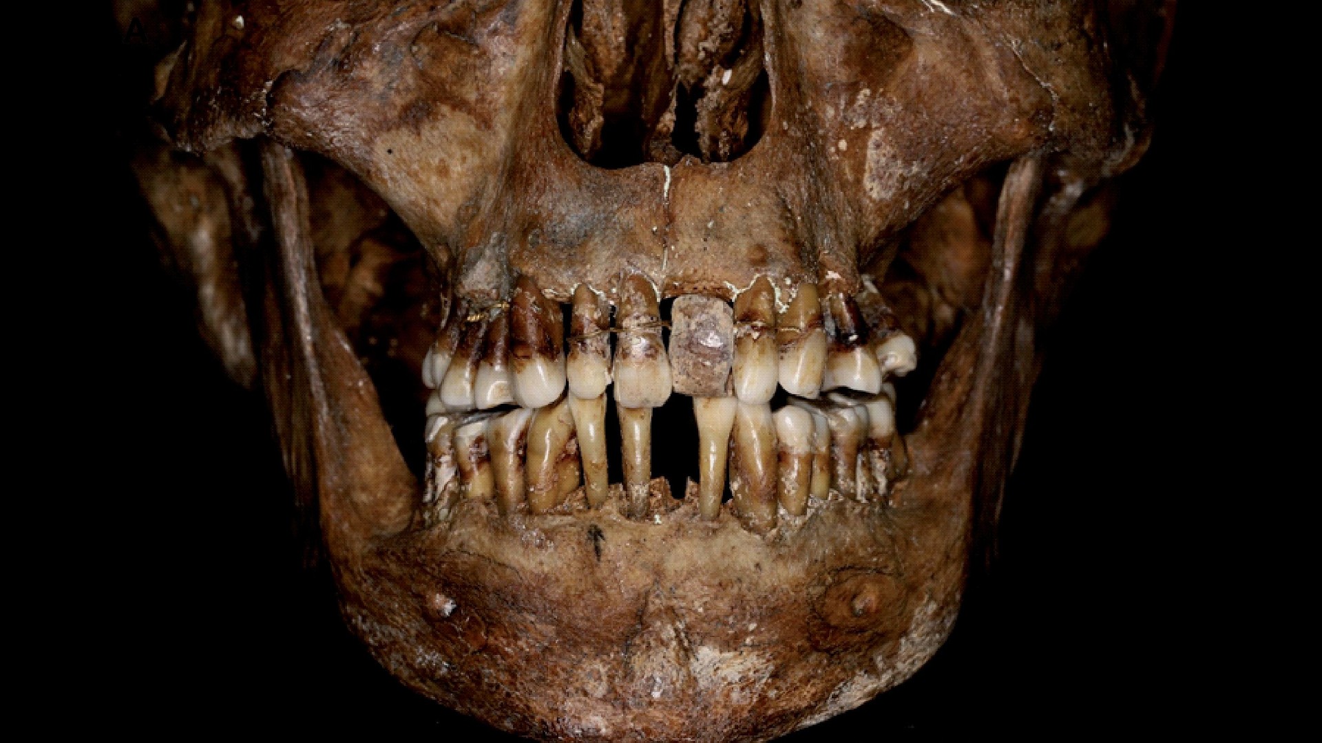 Seventeenth-century Frenchwoman’s ‘progressive’ gold dental work was doubtless torturous to her tooth