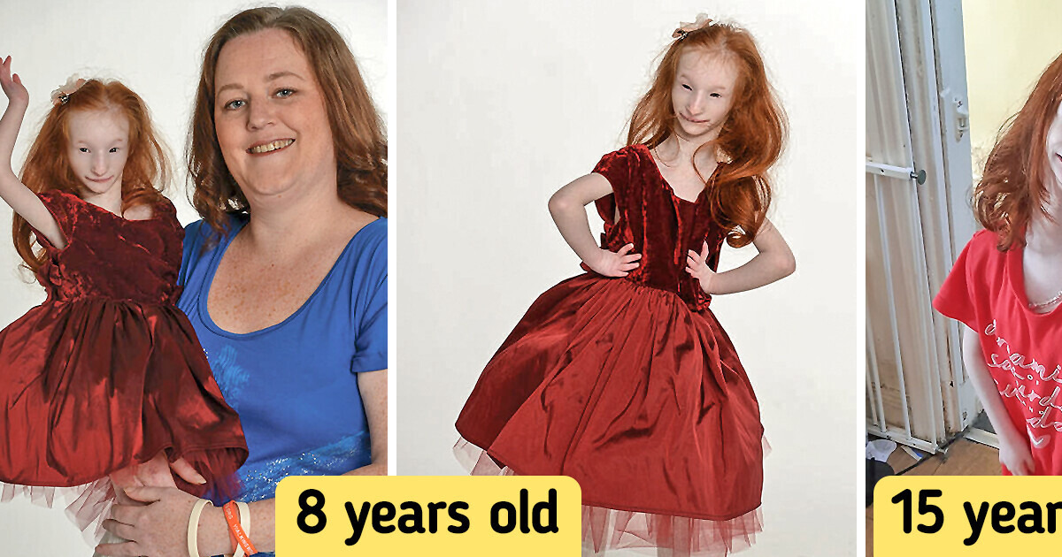 Meet “The Tiniest Woman” Who Survived Towards Medical doctors’ Prognosis and Celebrates Her sixteenth Birthday