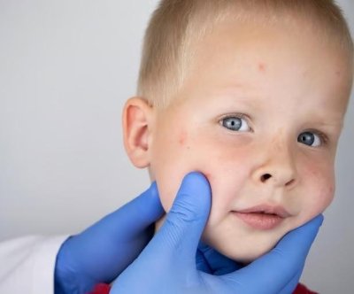 Florida surgeon common defers to folks over CDC throughout measles outbreak