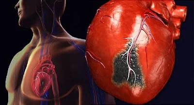 7 Early Warning Indicators Of Coronary heart Assault You Shouldn’t Ignore