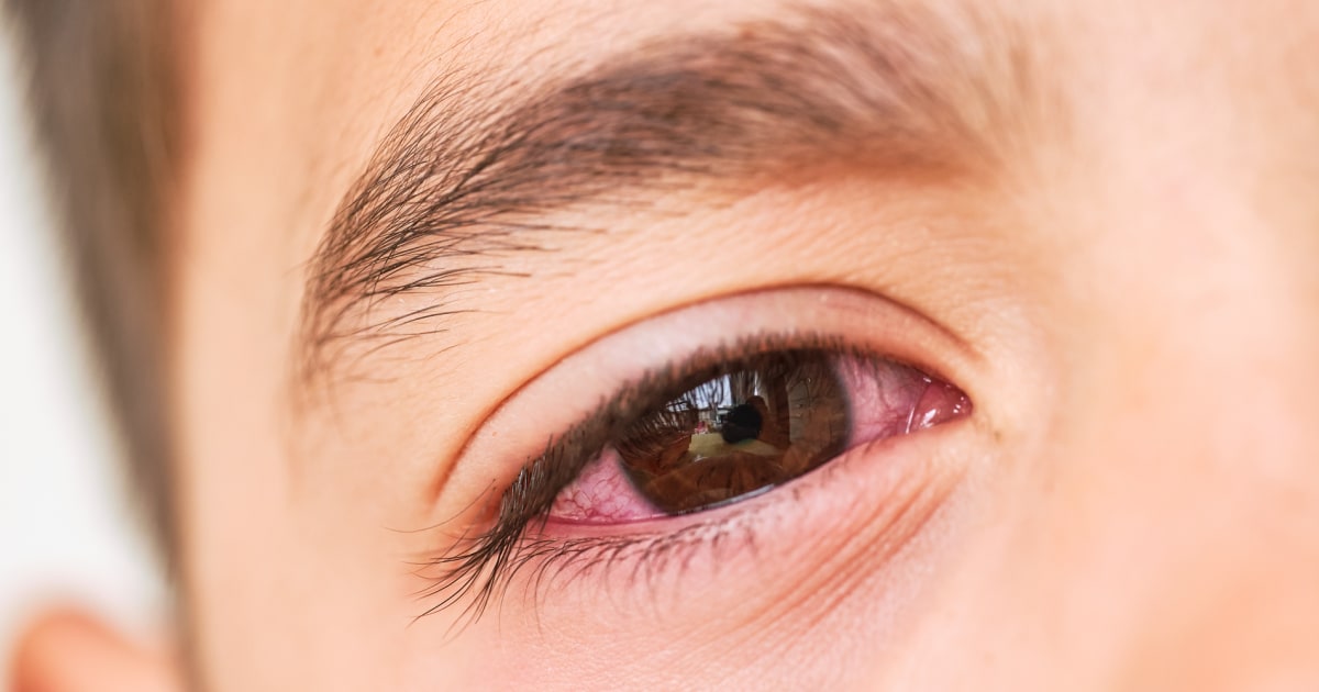 Most youngsters get antibiotics for pink eye. Specialists say they are not wanted.