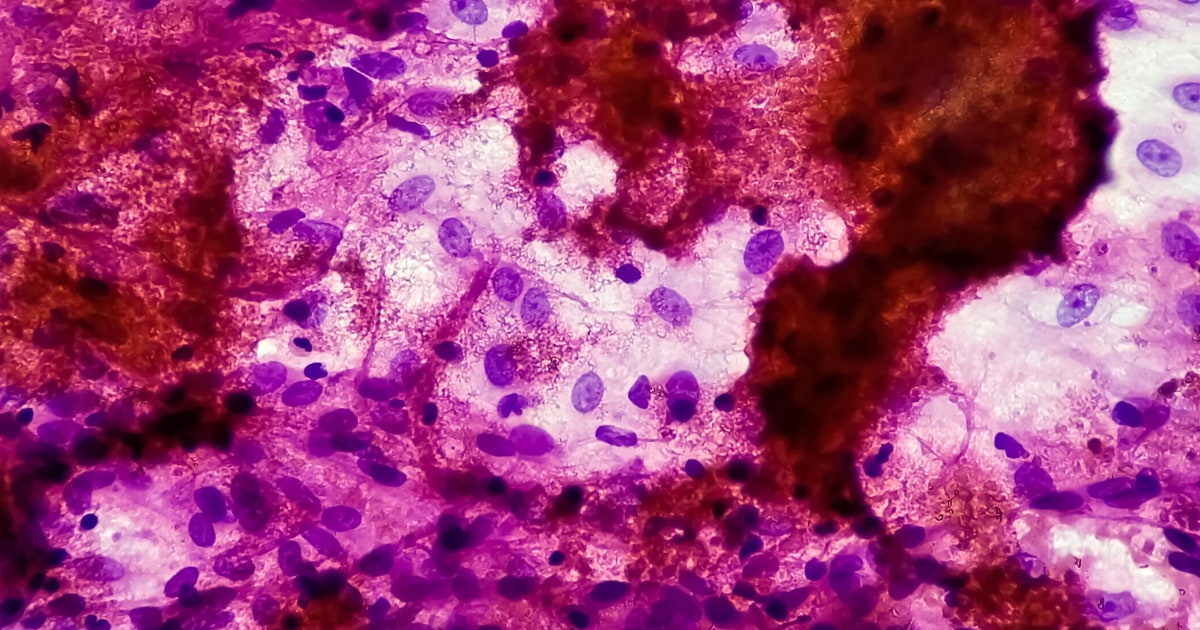 Tuberculosis affected person in Washington who was arrested for refusing remedy is lastly cured