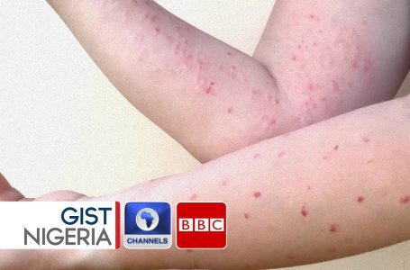 Mpox Outbreak In Nigeria: How To Keep Secure From The Viral Illness