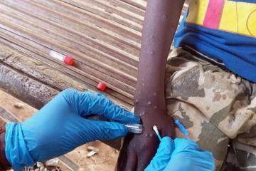 The arrival of MPOX in Angola
