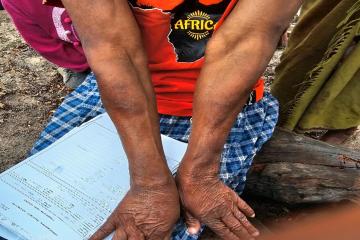 Strengthening Leprosy Elimination Efforts in Ngami and Okavango Districts