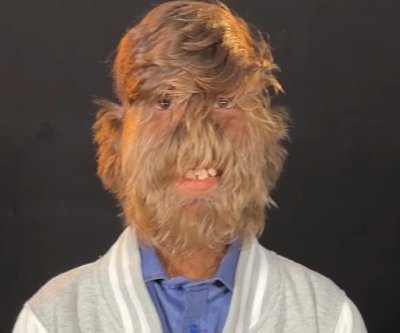 Watch: Indian teen with ‘werewolf syndrome’ earns Guinness World Report