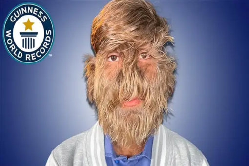 meet-the-indian-teenager-who-set-world-file-for-the-hairiest-face.webp Meet the Indian Teenager Who Set World File For the Hairiest Face