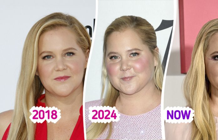 “Moon Face,” Web Customers Helped Amy Schumer to Discover Out the Downside After Being pregnant