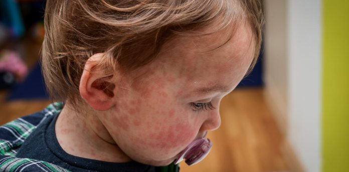 Measles circumstances are surging globally. Ought to kids be vaccinated earlier?