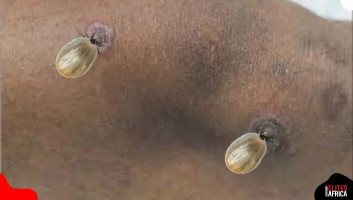 Can Lyme Disease Go Away on Its Own? 