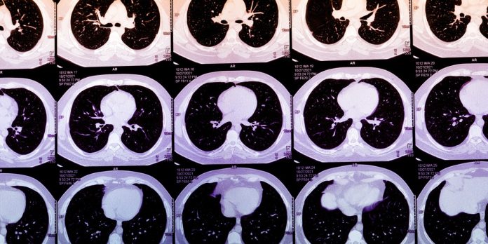 AI could predict who will have a heart attack