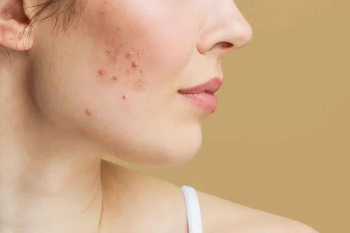 Adult Acne: Causes, Treatment, and Prevention Tips